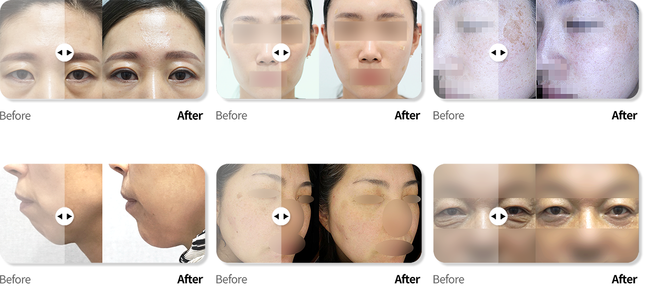 동탄점 케이스 전후사진